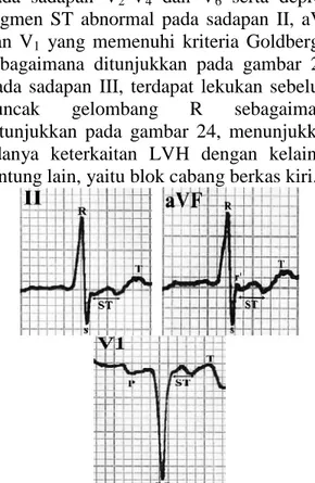 Gambar  22 memperlihatkan  hasil  rekaman EKG  pasien  5  dimana  terlihat  bahwa  pada sadapan I dan aVL terdapat tanda LV strain sebagaimana  yang  ditunjukkan  oleh  tanda lingkaran