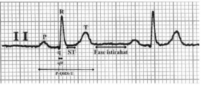 Gambar 11. Sadapan II hasil rekaman EKG pasien 1. Pasien  2  mempunyai  durasi  gelombang  q sampai puncak gelombang R = 40 ms