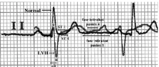 Gambar 15. Perbandingan  sadapan  II  hasil  rekaman EKG pasien 1 (normal) dengan pasien 5 (pasien dengan kelainan LVH).