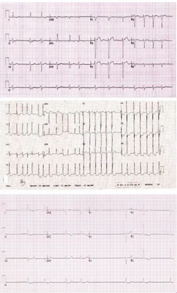 Gambar  4.  Rekaman  EKG  FA.  A.  FA  dengan  respon  