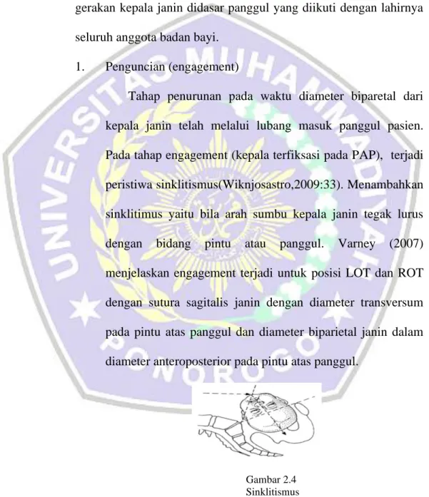 Gambar 2.4   Sinklitismus 