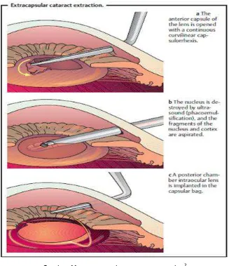 Gambar 11: extracapsular cataract extraction2 