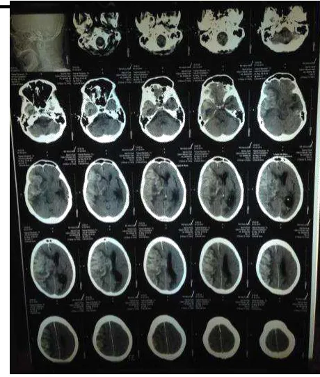Gambar 1. CT Scan kepala saat masuk RS 