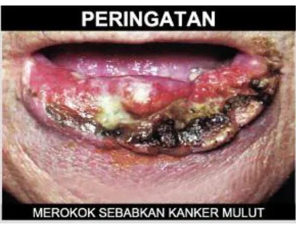 Gambar 4.1 Gambar Kanker Mulut 