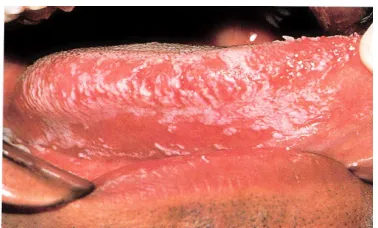Gambar 1. Pseudomembranous 