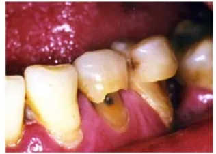 Gambar 11 Penampang frontal dan oklusal gigi erosi pada pasien dengan 