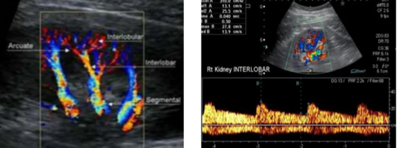 Gambar 1. Pengukuran Resistive Index. Sampel volume diletakkan pada arteri intrarenal (arcuata atau 