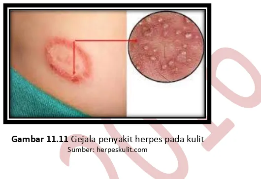 Gambar 11.11 Gejala penyakit herpes pada kulit 