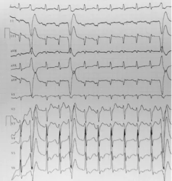 Gambar  1.  EKG  menunjukkan  multipel  VES  pada  saat  masuk rumah sakit