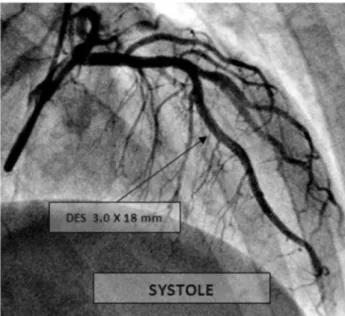 Gambar  4.  Angiografi  Koroner  setelah  pemasangan  stent  pada segmen MB menunjukkan patensi segmen mid-LAD  dengan 1 DES pada fase sistolik.