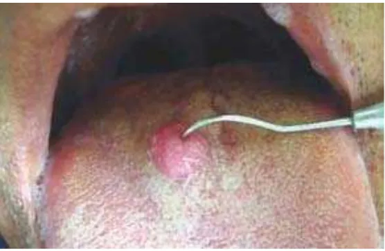 Gambar 2. Massa tumor pada bagian posterior dorsum lidah ditutupi oleh mukosa yang sehat.4 