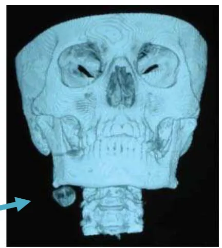 Gambar 8. Gambaran CT tiga-dimensi yang menunjukkan lokasi lesi pada inferior sudut rahang bagian kanan.1 