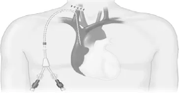 Gambar 2.3:Catheter Double Lumen 