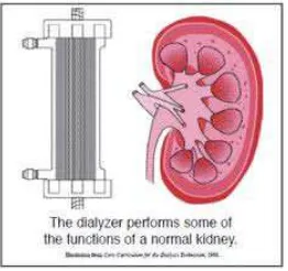 Gambar 2.4: Dializer (artificial kidney) 