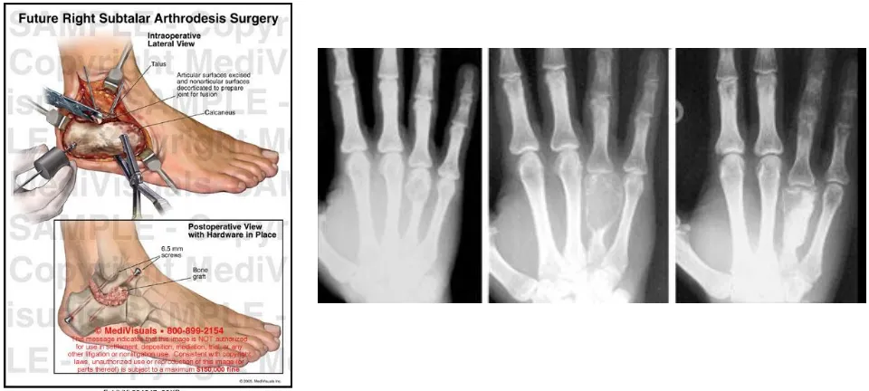 Gambar 1. Bone graft pada  joint arthrodhesis (kanan) , bone graft pada giant cell tumour (dikutip dari medivisual.com) 