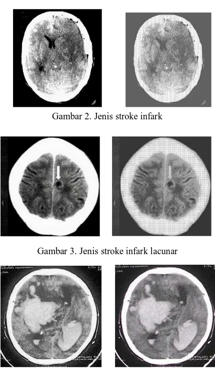 Gambar 2. Jenis stroke infark 