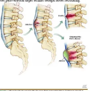 Gambar 3. Penyebaran basil tuberkel pada vertebra  