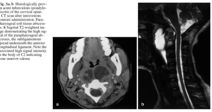 Gambar   7. Gambaran MRI Spondilitis  Tuberkulosa  