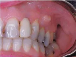 Gambar 1. Abses pada gigi