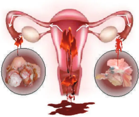 Gambar 4.1  Teori aliran balik darah haid (retrograde menstruation) melalui tuba falopii (Teori  Sampson)