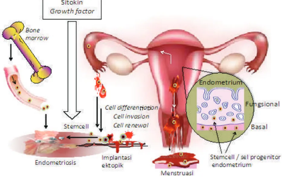 Gambar 4.7  Teori stem cell pada endometriosis. Sel progenitor (stem cell) yang berasal dari  lapisan basalis endometrium refluks ke peritoneum dan dengan stimulasi dari lingkungan  mikro misal: sitokin dan faktor pertumbuhan akan memicu fungsi stem cell y
