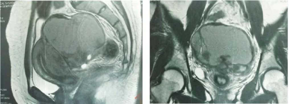 Gambar 8.3  Kista endometriosis dengan pemeriksaan MRI (Dokumentasi Klinik Fertilitas  Graha Amerta RSUD Dr Soetomo Surabaya)