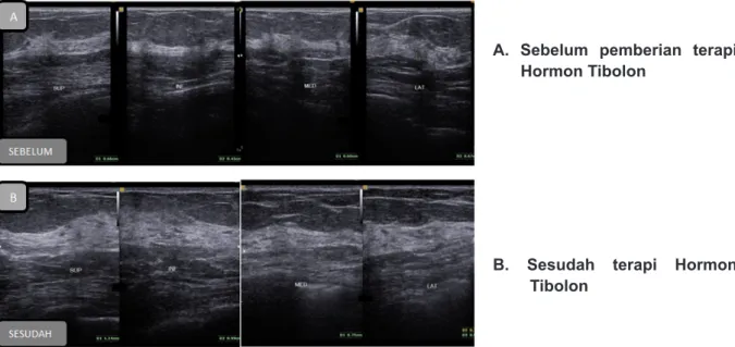 Gambar 1. Ketebalan jaringan fibroglandular payudara sebelum dan sesudah terapi hormon  tibolon 