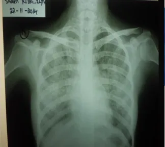 Gambar 2. Chest  –X ray: gambaran tuberkulosis milier 