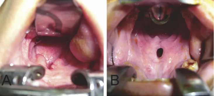 Gambar 1. Fistula pada palatum: (A) contoh tipe I, (B) contoh tipe II Salah satu komplikasi dari operasi  palatoplasty 