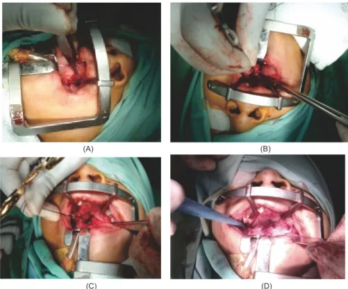 Gambar  5. Rangkaian operasi: (A) Pemisahan mukosa nasal dan mukosa oral, (B) Proses penjahitan 