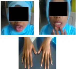 Gambar 1. Tampilan klinis berupa hiperpigmentasi  pada lidah, bibir, dan buku jari tangan