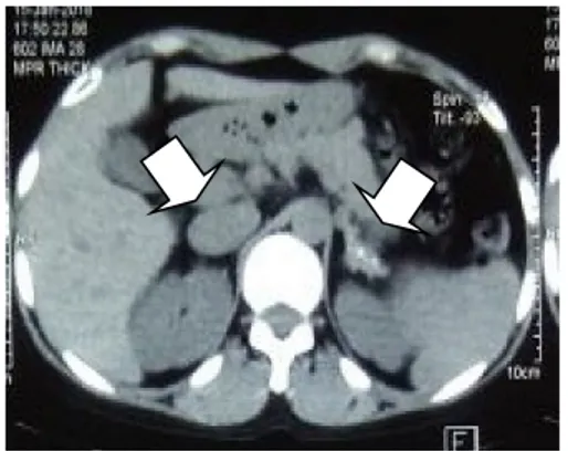 Gambar 2. CT Scan Adrenal Pasien menunjukkan  pembesaran kelenjar adrenal bilateral disertai  kalsifikasi multipel (panah putih) 