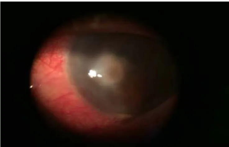 Gambar 1. Segmen anterior mata kiri pada kunjungan pertama 