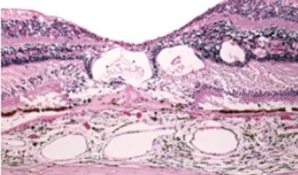Gambar 1. Histopatologi fovea; ruang cystoid dengan  transudat di dalam 