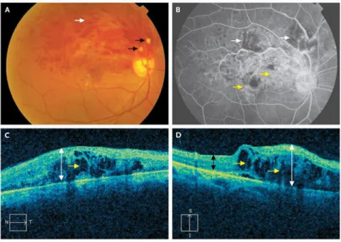 Gambar 1. Oklusi vena retina pada kuadran superotemporal yang pada kasus ini terjadi unilateral (mata kanan)