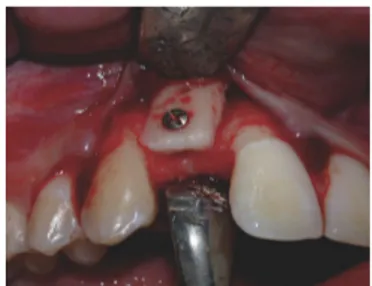 Gambar 3.  Gigi tiruan tetap pada kedua gigi insisiv sentral, insisiv lateral kiri dan kaninus kiri