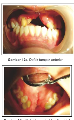 Gambar 12b. Defek tampak oklusal/ palatal