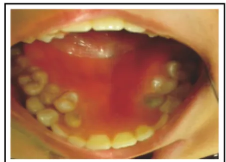 Gambar 16. Pasien dengan gigi tiruan  overlay thermoplastic resin.