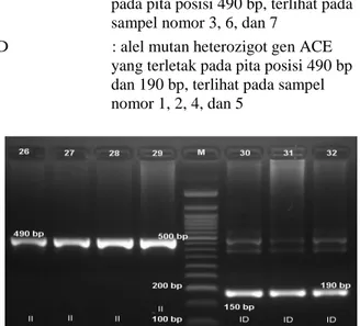 Tabel 2. Distribusi genotipe dan alel polimorfisme  insersi/delesi (I/D) gen ACE intron 16 pada pasien 