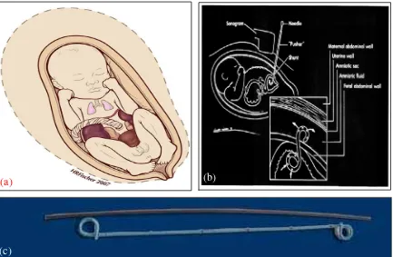 Gambar 6.  (a) Obstruksi Traktus Urinarius Bagian Bawah, (b) Posisi Double Pigtail Catheter in Utero, (c) Double Pigtail Catheter.14,15,16 