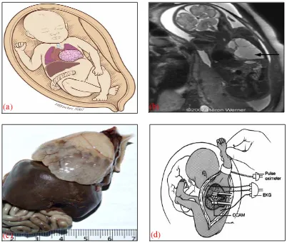 Gambar 7.  (a) CCAM in utero, (b) MRI (coronal T2 weighted) menunjukkan kista dengan intensitas sinyal yang tinggi (tanda panah), (c) CCAM pada autopsi, (d) Teknik Reseksi CCAM in utero.17,18,20 