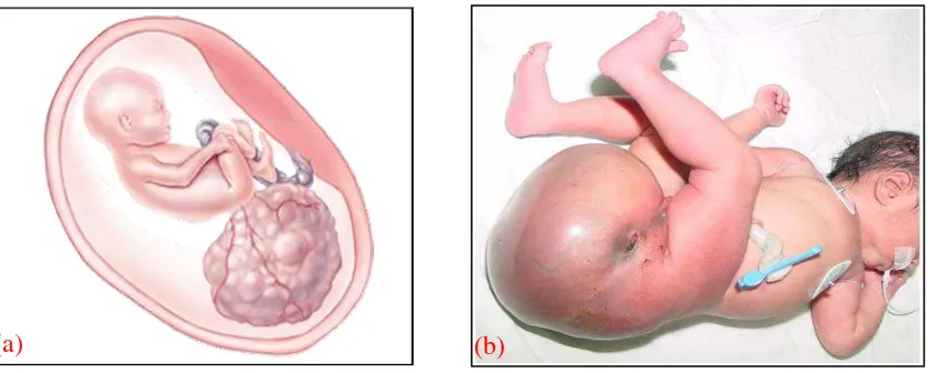 Gambar 10.  (a) Teratoma sakrokoksigeus in utero, (b) Bayi dengan teratoma sakrokoksigeus, yang meluas dari sakrum sampai bagian atas paha.26,28 