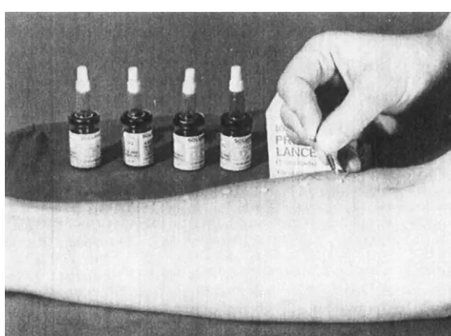 Figure 4Skin-prick testing. Results are read 15 min later, and the reactions are compared withthat produced by histamine (H in the picture) and with that produced by the diluent for the allergens(K).