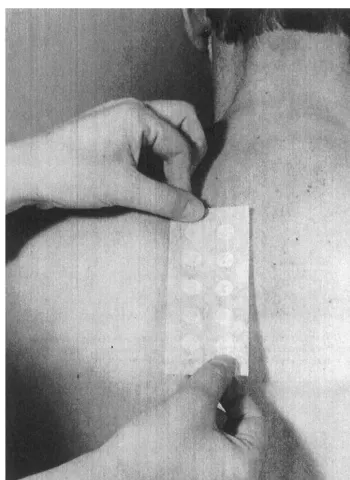 Figure 6Patch testing. Test chambers are ﬁxed on the back skin with a porous tape for 48 h.