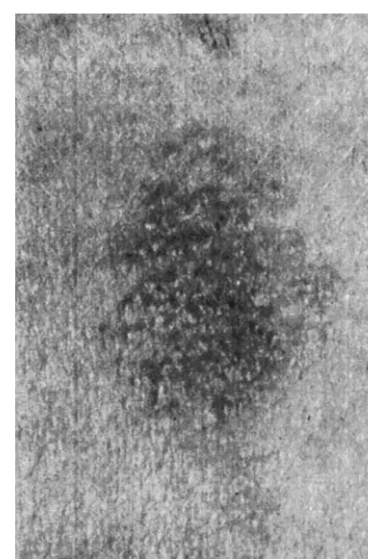 Figure 7Patch test result at 48 h. An allergic reaction comprises ‘‘mini-eczema’’ (redness andinﬁltration with tiny vesicles), which tends to spread to a larger area than the chamber size.