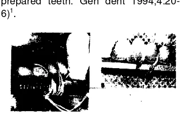 Gambar 7.Teknik Reynolds, a. Pegangan kaca mulut dililit ke GTJ dengan floss, b.GTJ terlepas (Sumber: Breeding LC, Dixon DL