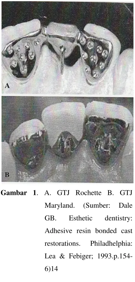 Gambar 1. A. GTJ Rochette B. GTJ 