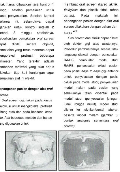 Gambar 6. Model studi dan oral screen dari bahan wax 