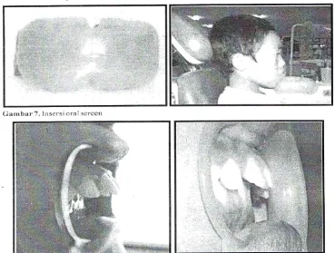 Gambar 8.  Sebelum insersi (kiri) dan seetlah pemakaian (kanan) oral screen 4 