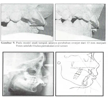 Gambar 10. Analisis sefalometri setelah pemakaian oral screen 